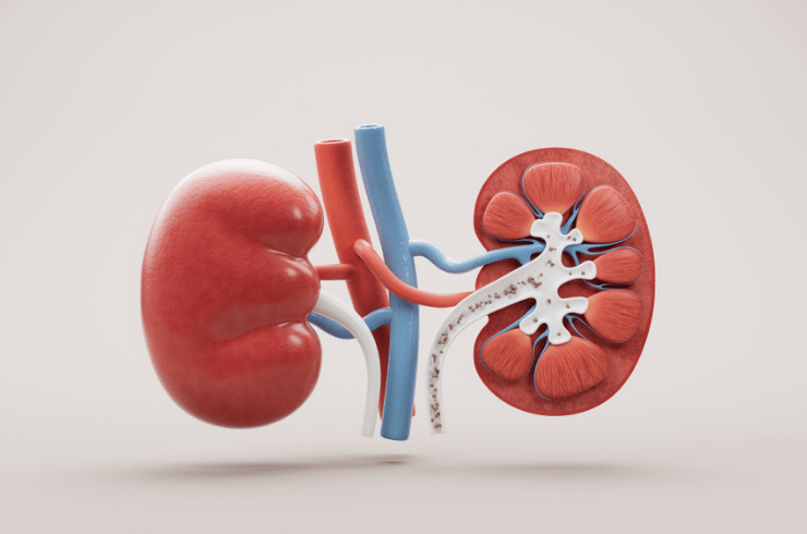 kidney-stone
